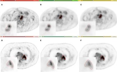 The Impact of Artificial Intelligence CNN Based Denoising on FDG PET Radiomics